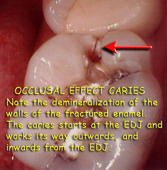 Occlusal effect5.3 web4.jpg